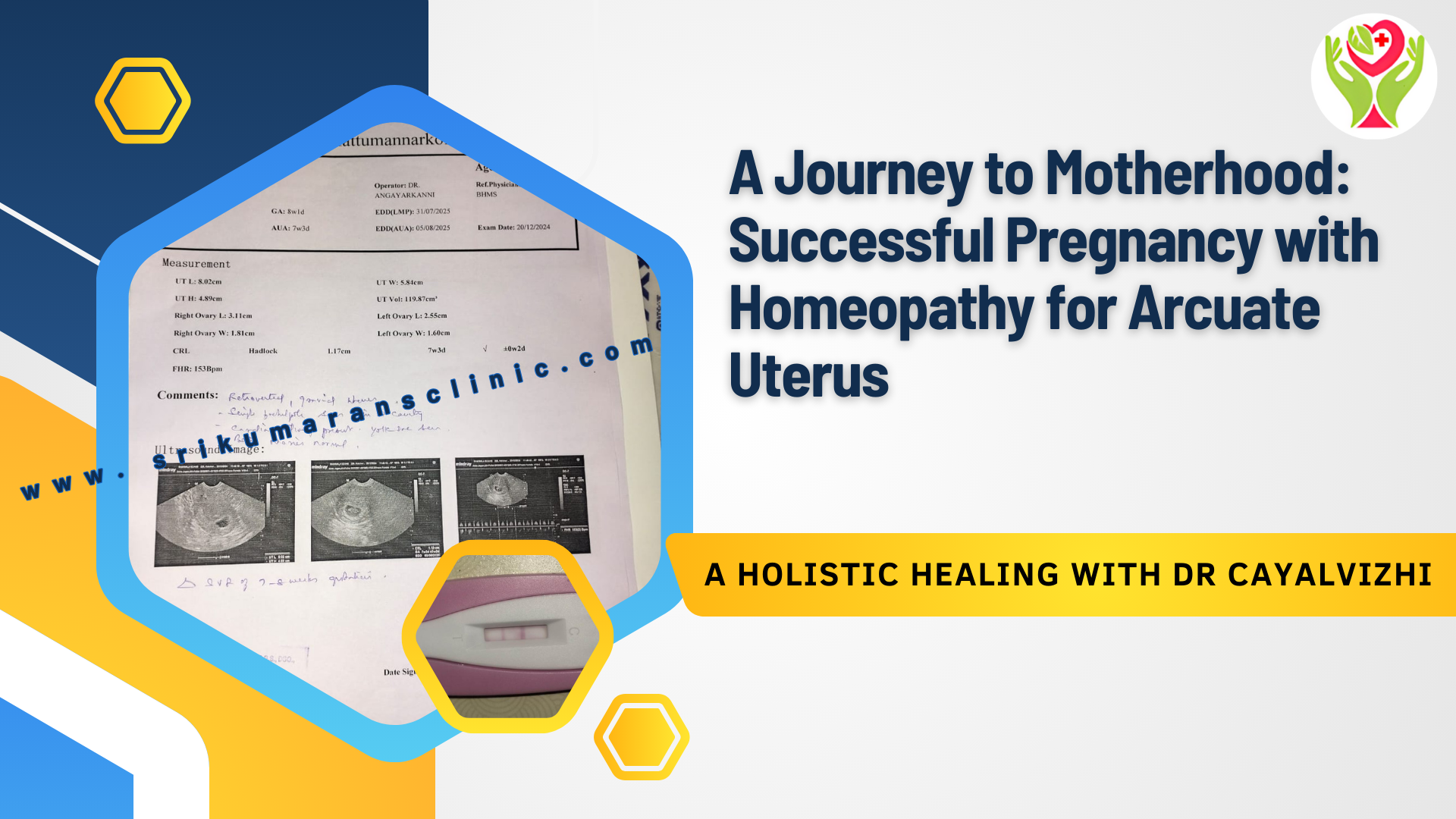 A Journey to Motherhood: Successful Pregnancy with Homoeopathy for Arcuate Uterus